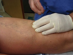sclerotherapy_treat1